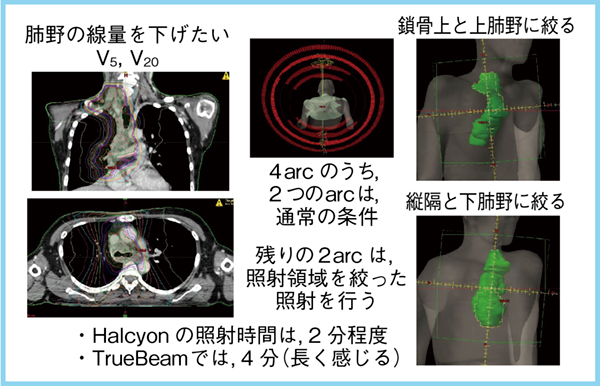 図2　4arc VMATの工夫