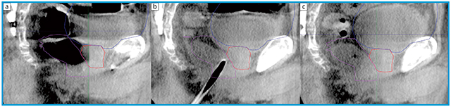 図1　直腸内ガス貯留例への対応（CBCT矢状断） 初回CBCTにて，ガス貯留のために直腸（ー）が著明に拡張しており，治療計画時の前立腺（ー）にまでかかっていた（a）。そこで，ネラトンチューブでガスを抜き（b），その後は治療計画時の位置関係を再現した状況で照射を行った（c）。治療計画時に比べて膀胱（ー）の容量が少ないが，膀胱容量の多寡によって前立腺の圧排や傾きはほとんど変わらない印象を持っている。