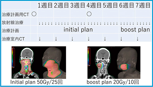 図1　Two-step法IMRT（右扁桃がんの一例）