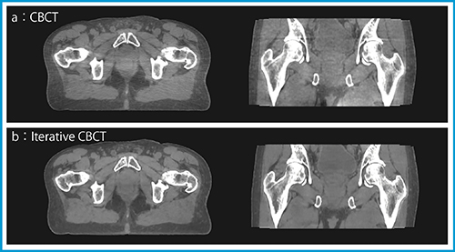 図2　前立腺治療患者におけるCBCTとi-CBCTの比較 （画像提供：株式会社バリアンメディカルシステムズ）