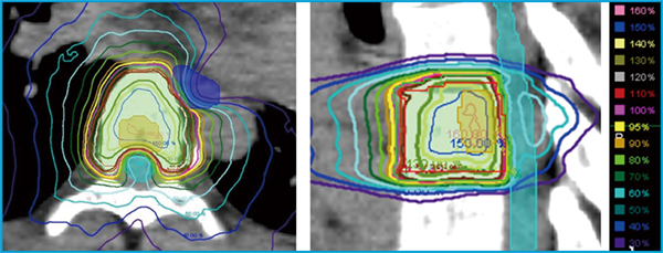 図1　脊椎SBRTの線量分布 脊椎SBRTでは，リスク臓器である脊髄と，標的である脊椎が隣接しているため，急峻な線量分布を作成し治療を行う必要がある。