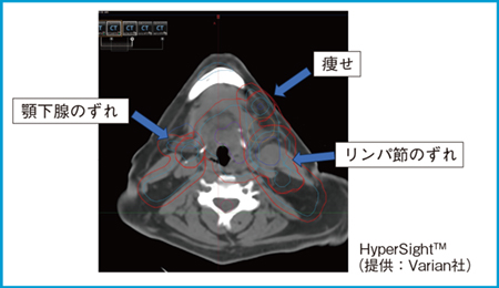 図1　HyperSightによるoffline-ARTワークフローの改善