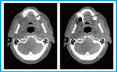 図2　HyperSightによるCBCT（顎） 左：HyperSight　右：従来のCBCT