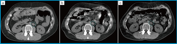 図1 Conventional CBCTとHyperSight CBCTの腸内ガスによるアーチファクトの比較 a:simulation CT b:conventional CBCT c:HyperSight CBCT (画像提供:株式会社バリアンメディカルシステムズ) 図1 Conventional CBCTとHyperSight CBCTの腸内ガスによるアーチファクトの比較 a:simulation CT b:conventional CBCT c:HyperSight CBCT (画像提供:株式会社バリアンメディカルシステムズ)