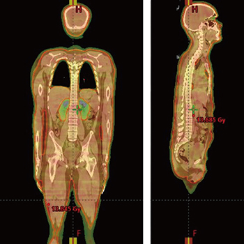 図2　VMAT-TBIの線量分布