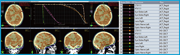 図4　症例1におけるHS-CBCT（左）とdCT（右）の線量分布の比較