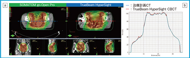 図4　子宮頸がんにおける線量分布精度の検証 a：治療計画CTとHyperSightを用いた治療計画の比較 b：同一断面での線量プロファイル：線量値の比較