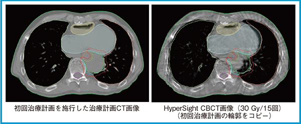 図5　胸部領域のoffline ARTの活用例