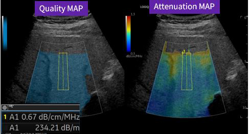 Ultrasound-guided attenuation parameter(UGAP) Ultrasound-guided attenuation parameter(UGAP)
