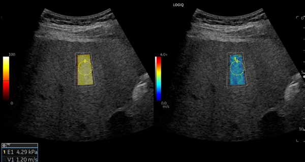 Shear Wave Elastography(SWE) Shear Wave Elastography(SWE)