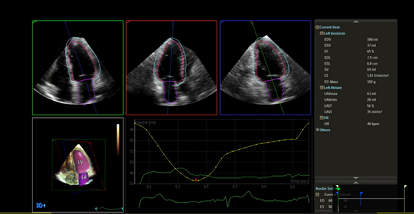 Dynamic HeartModel に対応 Dynamic HeartModel に対応