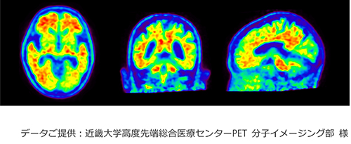Amyloid PET 画像例