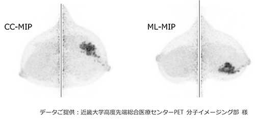 FDG PET画像例