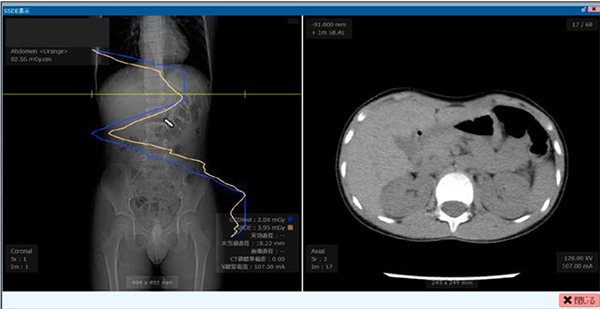 SSDE解析表示例 AAPM Task Group 220によるSSDEをスライス位置ごとに算出し，位置決め画像上にグラフ表示。位置決め画像上でカーソルを移動させることで，任意のスライス位置でのSSDE値を表示可能である。この表示例では，SSDE（黄色）と同時にCTDIvol（青色）も表示している。 その他選択することで管電流値，水等価直径値なども表示可能である。