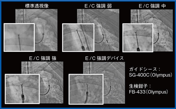 図1　Accentモード適用による視認性の向上（経気管支生検：TBLB） 強調を変えることで鉗子の視認性が向上している。