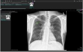 EIRL Chest Screening