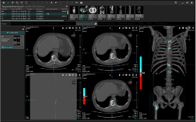 Temporal Subtraction For Bone