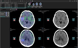 Ischemia analysis　