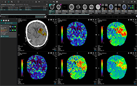 Brain Perfusion