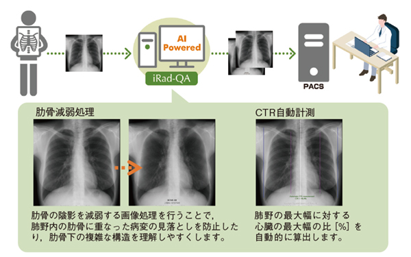 図1 「iRad-QA」での胸部XPのAI画像解析機能 図1 「iRad-QA」での胸部XPのAI画像解析機能