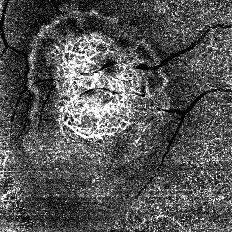中心窩下脈絡膜新生血管（CNV：choroidal neovascularization）