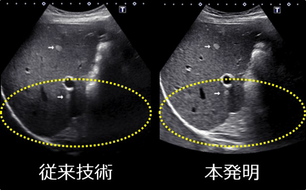 従来技術と本発明の超音波画像