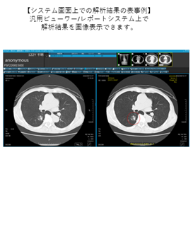 胸部CT画像解析AIエンジンDoctorNET MONCAD CTLN