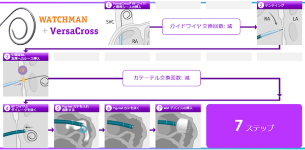 VersaCross ConnectとWATCHMAN を使用した左心耳閉鎖術 VersaCross ConnectとWATCHMAN を使用した左心耳閉鎖術