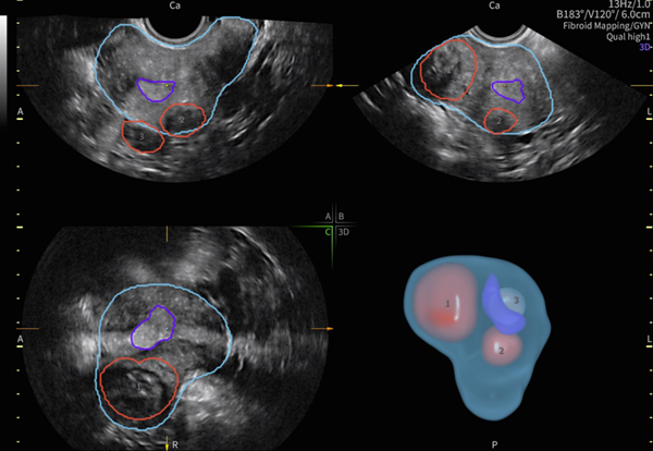 子宮筋腫と子宮,子宮内膜との位置関係を立体表示するFibroid Mappingは,医師同士や患者様とのコミュニケーション円滑化につながる 子宮筋腫と子宮,子宮内膜との位置関係を立体表示するFibroid Mappingは,医師同士や患者様とのコミュニケーション円滑化につながる