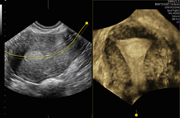 ラインを引くだけで子宮の断面を自動表示するUterine Traceは,子宮形態の把握に役立つ ラインを引くだけで子宮の断面を自動表示するUterine Traceは,子宮形態の把握に役立つ