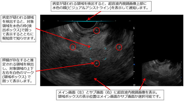 超音波内視鏡検査において，富士フイルムが開発したソフトウェアが，膵臓が存在すると推定される領域および膵充実性病変が疑われる領域を検出する様子