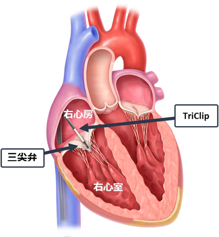 TriClip留置例