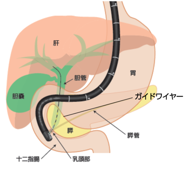 十二指腸に到達したスコープから,乳頭部を経由して胆管にガイドワイヤーを挿入するイメージ図 十二指腸に到達したスコープから,乳頭部を経由して胆管にガイドワイヤーを挿入するイメージ図