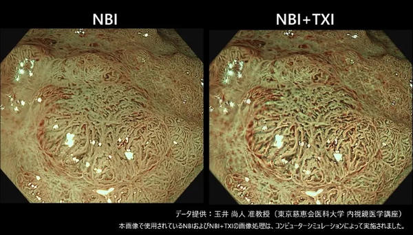 左：NBIモード　右：NBI+TXIモード　イメージ画像