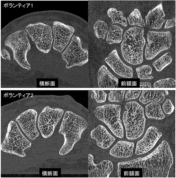 図 2： 健常ボランティア2例の手部（手根骨部）のCT画像。