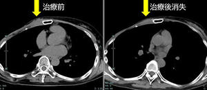 FDG-PET陽性の浅在性腫瘍に対するBNCT（jRCTs031240204）治療4例目：再発乳がん