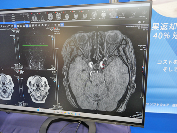 LOOKRECでEIRL Brain Aneurysmの結果を表示