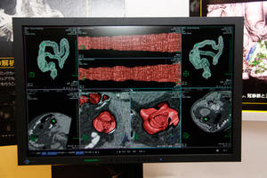 “大腸解析”：中央上が腸管径展開