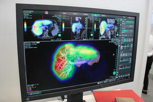 SYNAPSE VINCENTの新機能「肝機能解析」
