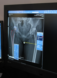 IDS7で利用できる整形外科のインプラントシミュレーションツールOrtho Pkg