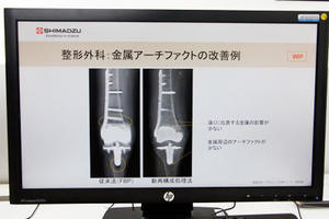 開発中の新再構成処理法は，金属アーチファクトを抑え，インプラントと骨の境界を明瞭に描出する。