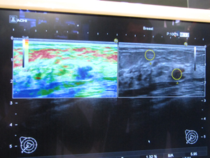 組織の弾性を画像化する「Real-time Tissue Elastography（RTE）」（HI VISION Preirus）