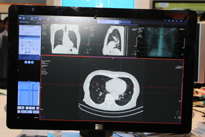 15のアプリケーションが追加された「syngo.via」。画面は“MM Oncology Lung CARE”