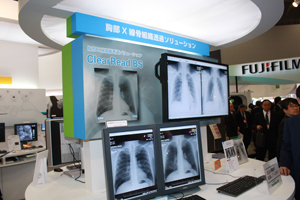 胸部X線骨組織透過ソリューション「Clear Read BS」