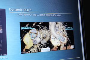 「TAVR術前プランニング」にはPhyZiodynamicsのDynamic ROIなどの技術が使われている。
