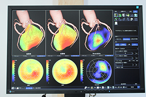 冠動脈CTと心筋SPECTをフュージョンしたFusion EX