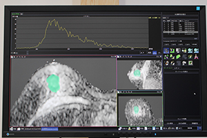 腫瘍の悪性度を予測するADCボリュームヒストグラム解析