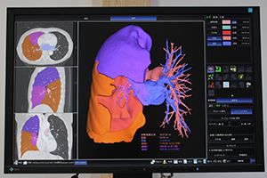 セグメンテーション手法を応用した肺野解析