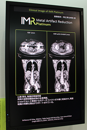 IMR Platinumは金属アーチファクト抑制技術“O-MAR”との併用が可能IMR Platinumは金属アーチファクト抑制技術“O-MAR”との併用が可能