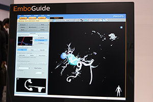 自動で腫瘍の栄養血管候補を抽出する「EmboGuide」
